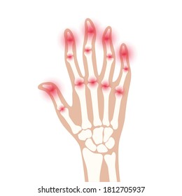 Pain and inflammation in hand on x ray. Rheumatoid arthritis symptom on human joints and bones. Skeleton scan concept. Finger disease flat vector illustration. Banner, poster for clinic and hospital