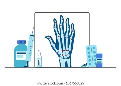 Pain and inflammation in hand on x ray. Rheumatoid arthritis symptom on human joints and bones. Doctor help and medical exam in clinic. Skeleton scan concept. Finger disease flat vector illustration.