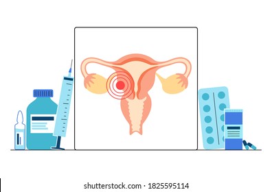 Pain or inflammation in uterus. Women health clinic concept. Female reproductive system and internal organ. Concept of woman medicine and gynecology. Ovaries, vagina, womb flat vector illustration.