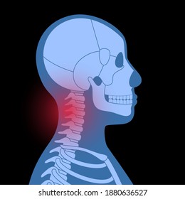 Pain In Neck Or Spine Bones. Skeleton X Ray Silhouette Medical Poster. Joints And Cartilage In Human Body Concept. Rheumatoid Arthritis, Inflammation, Backbone Disease Concept Flat Vector Illustration