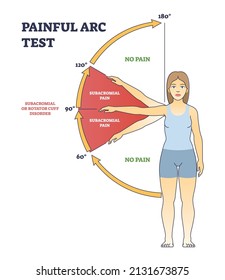 Painful arc test and physiopedia syndrome medical diagnosis outline diagram. Labeled educational position scheme with subacromial pain angle in hand movement vector illustration. Rotator cuff disorder