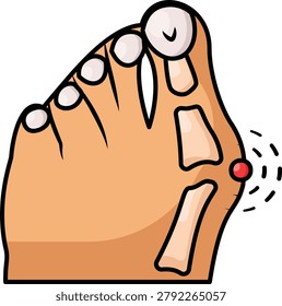 painful bunion on the foot concept, forefoot pain visualization vector icon design, big toe bump and joint pain stock illustration
