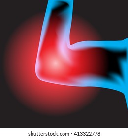 Painful elbow