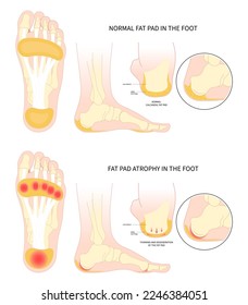 Painful heel bone spurs in Plantar fat pad atrophy tear high ankle shoes feet sport fascia arch of Lupus shots steroid for Achilles tendon