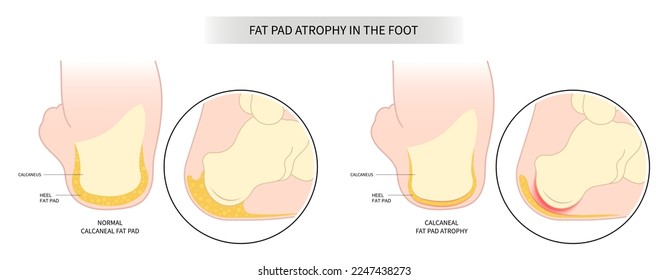 Painful heel bone spurs in Plantar fat pad atrophy tear high ankle shoes feet sport fascia arch of Lupus shots steroid for Achilles tendon