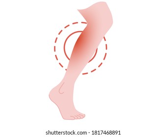 Painful Leg Concept With Pain Red Circle Cartoon Flat Design Vector Illustration On White Background