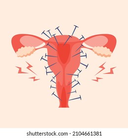 Painful menstruation concept trendy flat illustration. Uterus inflammation, endometriosis,  banner design. Cancer symptom, cycle problems, pms background.