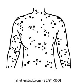 Painful Rash On Back Vector Icon. Human Torso With Sores, Ulcers, Blisters On The Skin. Symptom Of A Viral, Bacterial, Allergic Disease. Smallpox, Dermatitis, Eczema. Black Outline Isolated On White