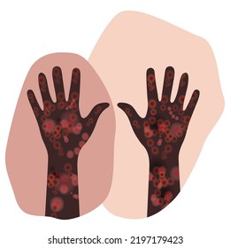 Painful rash on both arms with dark brown skin tone. Symptoms of patient with meningitis.  Disease manifestation signs. Derma condition design. Irritation, monkeypox virus, dermatitis and drug allergy