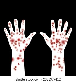 Painful rash on hands. Spots on hands with white skin tone. Symptoms of patient with meningitis. Disease manifestation signs. Rash, dermatitis, allergies or pimples on hands. Medicine or dermatology.