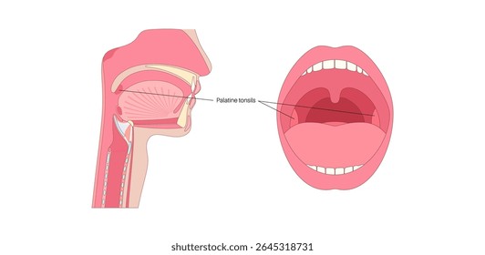 Palatine tonsils in the oropharynx region, lips and teeths infographic poster. Tonsils in oral cavity between palatoglossal and palatopharyngeal arches in the human head medical vector illustration