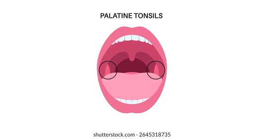 Palatine tonsils in the oropharynx region, lips and teeths infographic poster. Tonsils in oral cavity between palatoglossal and palatopharyngeal arches in the human head medical vector illustration