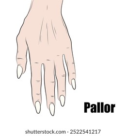 A palidez pode ser causada por: anemia (perda de sangue, má nutrição ou problemas com o sistema circulatório).