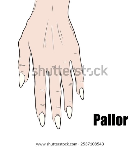 Paleness can be caused by: Anemia (blood loss, poor nutrition, or problems with the circulatory system).