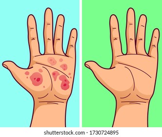 La palma con eczema, antes de