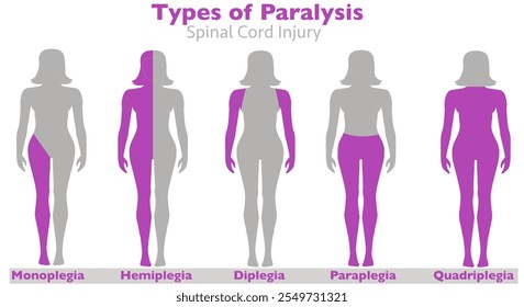 Paralisia, lesão da medula espinhal, tipos de paralisia. Monoplegia, paraplegia, hemiplegia, diplegia, quadriplegia. causas, acidente vascular encefálico, tumor, lesão nervosa lesões cerebrais. Mulher lateral, corpo humano. ILUSTRAÇÃO Vetorial