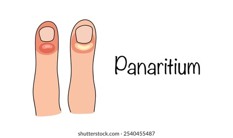Panaritium. Two fingers of a person with symptoms of felon. Purulent inflammation in the area of the fingers. Simple vector illustration for different uses. 