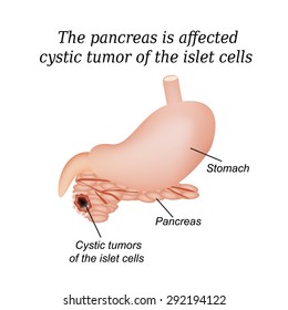The pancreas is affected cystic tumor of the islet cells. Vector illustration on isolated background.