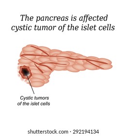  The pancreas is affected cystic tumor of the islet cells. Vector illustration on isolated background. Pancreatitis.