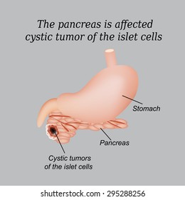 The pancreas is affected cystic tumor of the islet cells. Vector illustration on a gray background.
