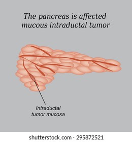 The pancreas is affected mucous intraductal tumor. Vector illustration on a gray background.