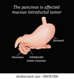 The pancreas is affected mucous intraductal tumor. Vector illustration on a black background.