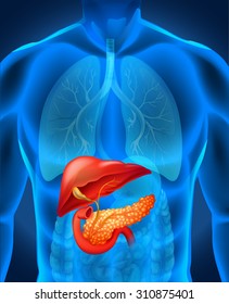 Pancreas Cancer In Human Body Illustration