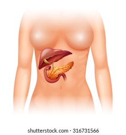 Pancreas cancer in human illustration