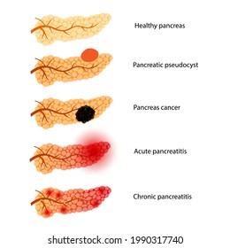 Pancreas disease concept. Acute and chronic pancreatitis, pancreatic cancer and pseudocyst. Pain and inflammation in digestive system. Human internal organs anatomical examination vector illustration.