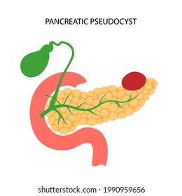 Concepto de enfermedad del páncreas. Pancreatitis aguda y crónica, cáncer pancreático y pseudocista. Dolor e inflamación en el aparato digestivo. Ilustración vectorial de examen anatómico de órganos internos humanos.