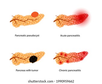 Pancreas Disease Concept. Acute And Chronic Pancreatitis, Pancreatic Cancer And Pseudocyst. Pain And Inflammation In Digestive System. Human Internal Organs Anatomical Examination Vector Illustration.