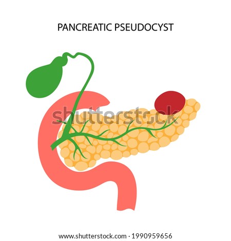 Pancreas disease concept. Acute and chronic pancreatitis, pancreatic cancer and pseudocyst. Pain and inflammation in digestive system. Human internal organs anatomical examination vector illustration.