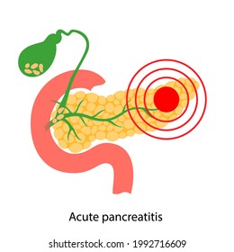 Logo de la enfermedad del páncreas, pancreatitis aguda. Nombramiento médico y tratamiento en clínica. Dolor e inflamación en el aparato digestivo. Organismos internos humanos examen anatómico ilustración vectorial plana