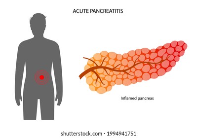 Pancreas disease logo, acute pancreatitis. Medical appointment and treatment in clinic. Pain and inflammation in man silhouette. Human internal organs anatomical examination flat vector illustration.