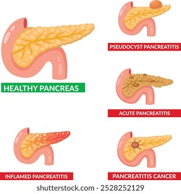 Concepto de enfermedades del páncreas pseudoquiste cáncer inflamado páncreas de salud aguda y crónica