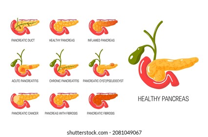 Pancreas diseases concept. Set of anatomical icons for medical designs. Vector illustration isolated on a white background in cartoon style.