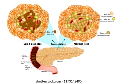 The Pancreas Has Many Islets That Contain Insulin-producing Beta Cells And Glucagon-producing. Type 1 Diabetes ( Beta Cell Destroyed). 