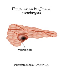Pancreas pseudocyst affected. Vector illustration on isolated background.