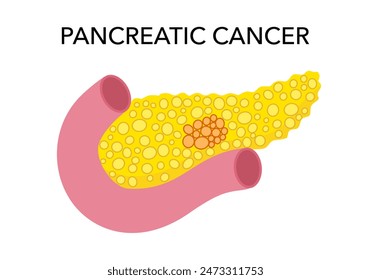 Pancreatic cancer concept on white background.