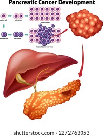 Pancreatic Cancer Development Infographic illustration