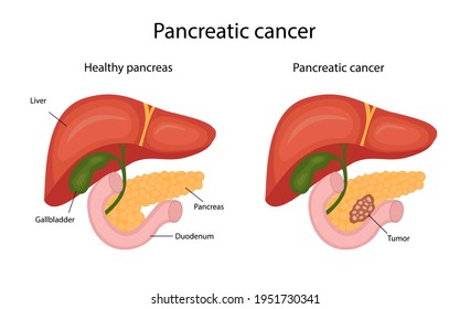pancreatic cancer pancreatitis)