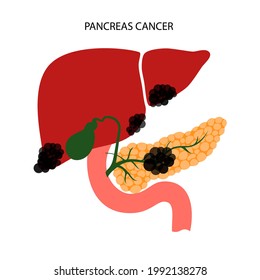 Pancreatic Cancer Logo Pancreas Disease Medical Stock Vector Royalty Free