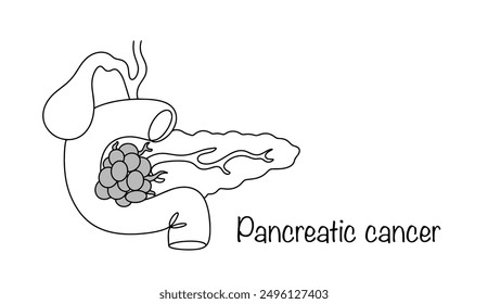 Pancreatic cancer. A malignant neoplasm arising from the epithelium of glandular tissue or pancreatic ducts. Drawn pancreatic oncology. Simple vector.