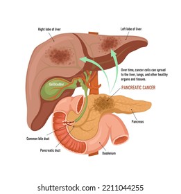 Pancreatic cancer. Spread of cancer cells from the pancreas to the liver