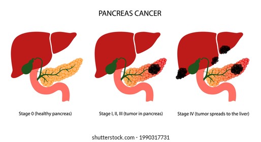 Pancreatic Cancer Stages, Pancreas Disease. Medical Appointment And Treatment In Clinic. Tumor, Pain And Inflammation In Digestive System. Human Internal Organs Anatomical Exam Vector Illustration.