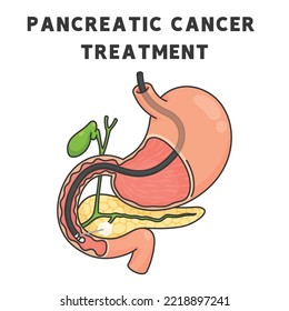 pancreatic cancer treatment chart in science subject kawaii doodle vector cartoon