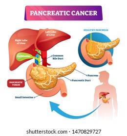 Diabetes Complications Affected Organs Round Info Stock Vector (Royalty ...