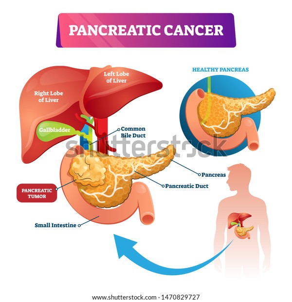 Pancreatic cancer vector illustration. Labeled\
sick stomach oncology disease scheme. Diagram with inner organs\
structure, healthy and tumor comparison. Liver lobes, gallbladder\
and intestine\
example.