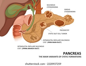 Pancreatic cyst. Main variants of cystic formations (cystadenoma ,pseudocyst  etc.)