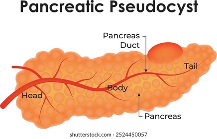 Pseudocisto Pancreático Cabeça Corpo Pâncreas Duto Pancreático Ilustração Vetorial